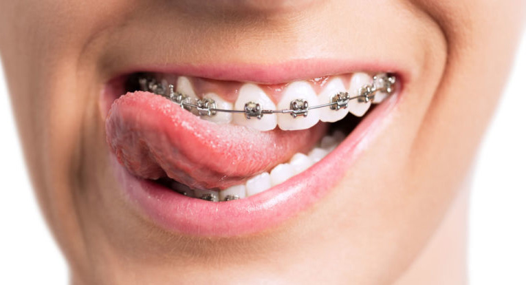 preguntas y cosas que deberías saber sobre ortodoncia