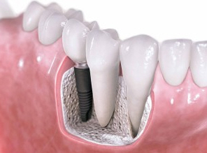 Especialistas en Implantes Dentales en Madrid