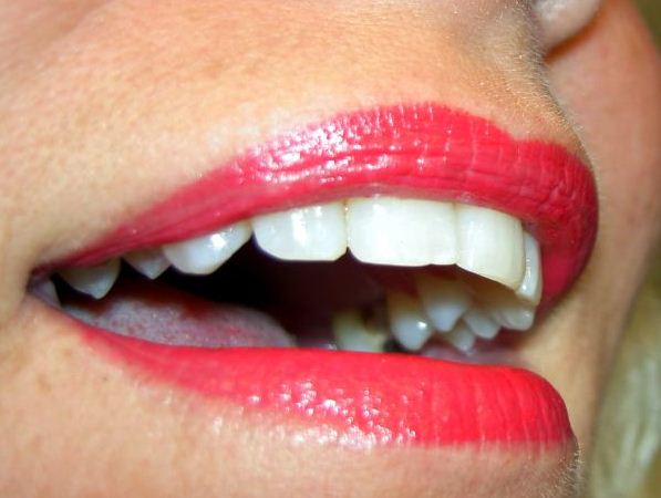 los dientes empastados pueden volver a tener caries en el futuro