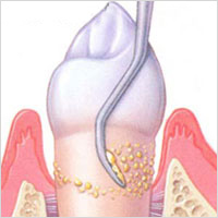 raspado periodontal para gingivitis