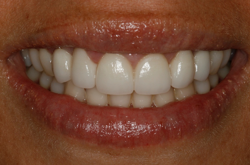 uso del disilicato de litio en coronas dentales y prótesis