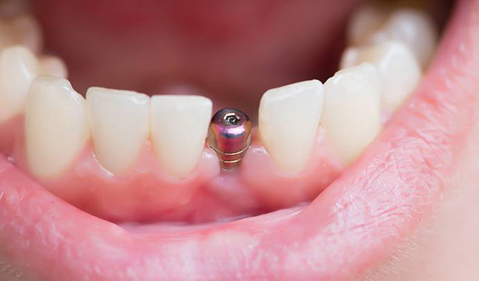 que son implantes dentales post extracción