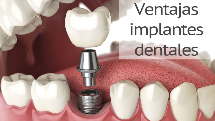 Ventajas y beneficios de usar implantes dentales para salud y estética dental
