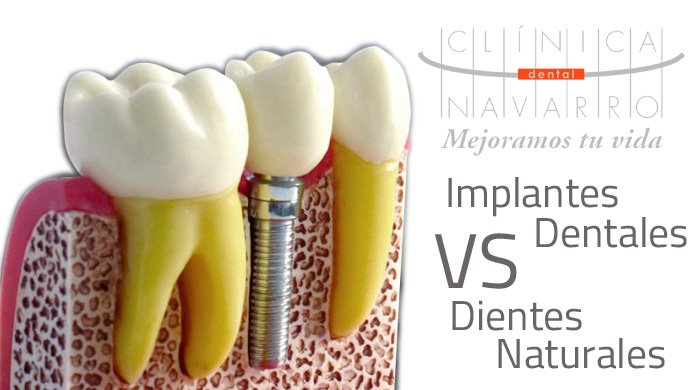 parecidos de los implantes dentales con los dientes naturales