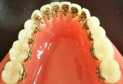 ortodoncia interna que no se ve