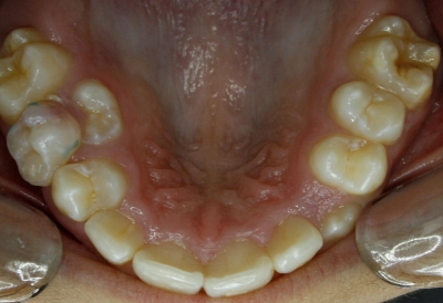 alteraciones erupción dentaria sin ortodoncia