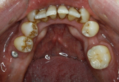 perdida de piezas dentales sin ortodoncia