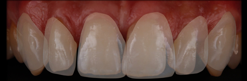 previsualización dientes nuevos sobre dientes iniciales DSD
