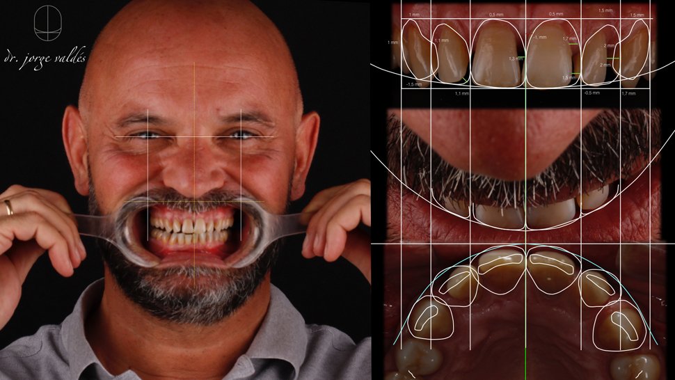 imagen principal del proceso de dsd para espaciado dental