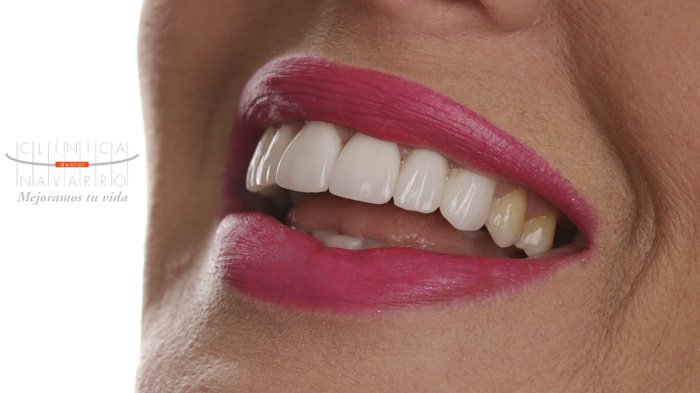 dudas, preguntas y respuestas sobre implantes dentales