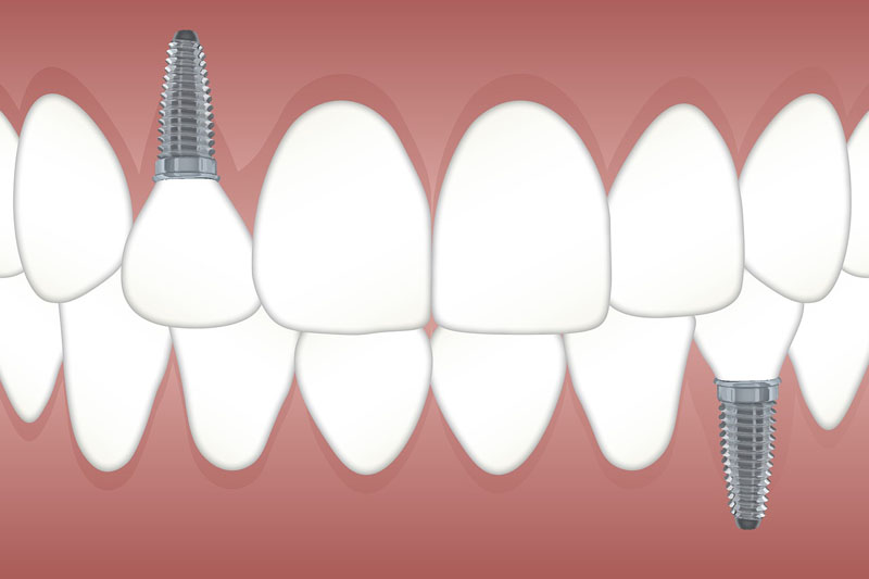 cosas que saber antes de ponerme implantes dentales