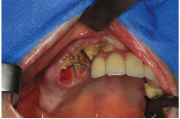 afección dental en maxilares por el uso de bifosfonatos 