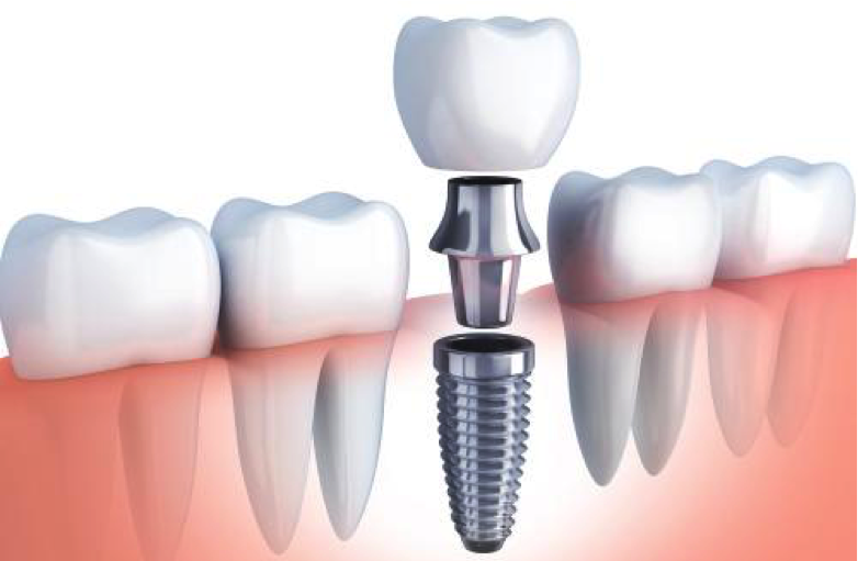 faqs y preguntas frecuentes de los pacientes sobre implantes dentales y su proceso de colocación