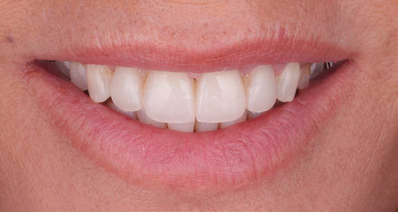 Tipos de blanqueamiento dental y preguntas generales sobre el tratamiento