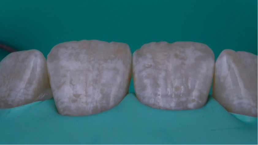 imagen de antes de microabrasión del esmalte, dientes manchados