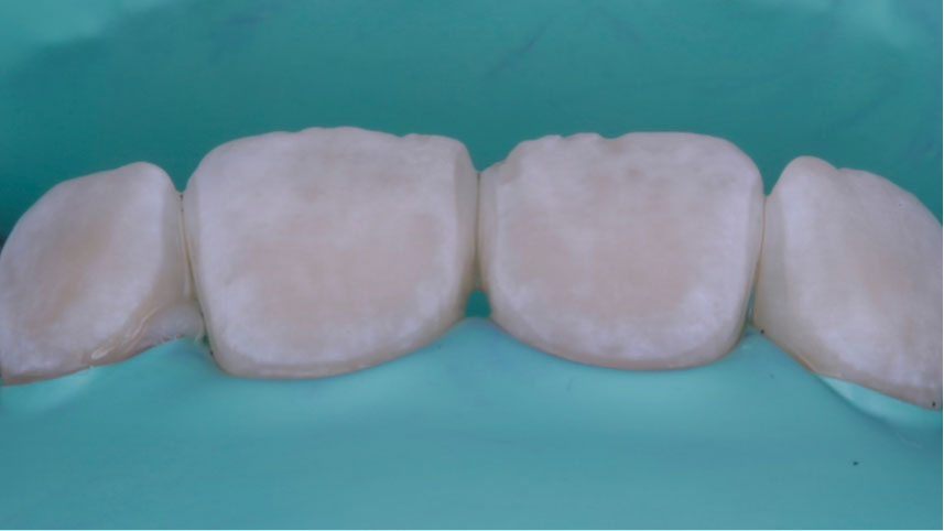 resultados de microabrasión del esmalte dental