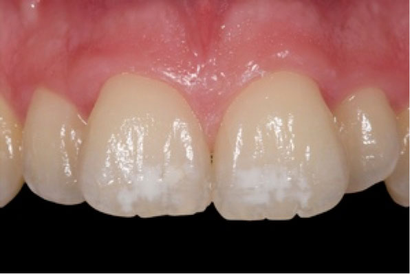 microabrasión del esmalte para eliminar las manchas de los dientes