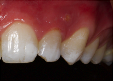 Foto de absceso dental localizado