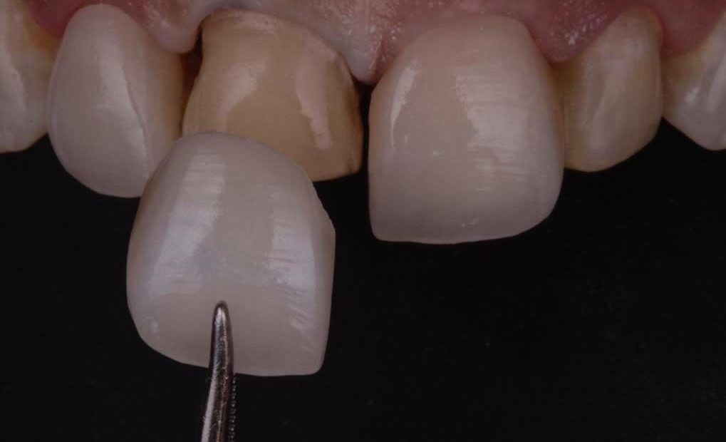 tipos de carillas dentales, usos, ventajas y mantenimiento
