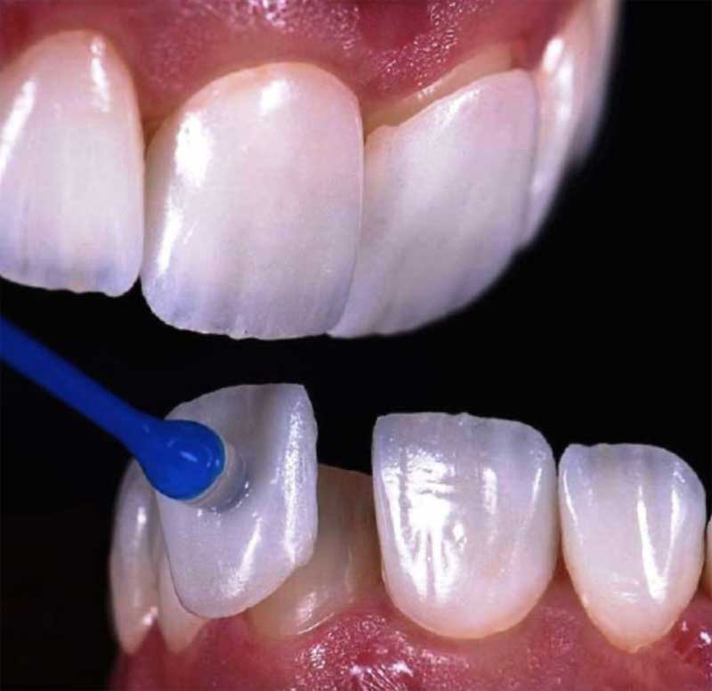 Características y ventajas de las carillas dentales de resina - Carillas  dentales
