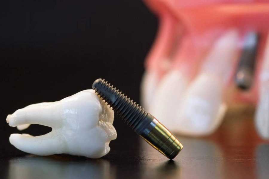 motivos y casos donde un implante dental puede fracasar o ser rechazado
