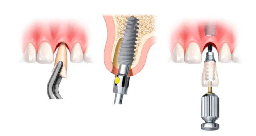 Colocación de un implante dental paso a paso