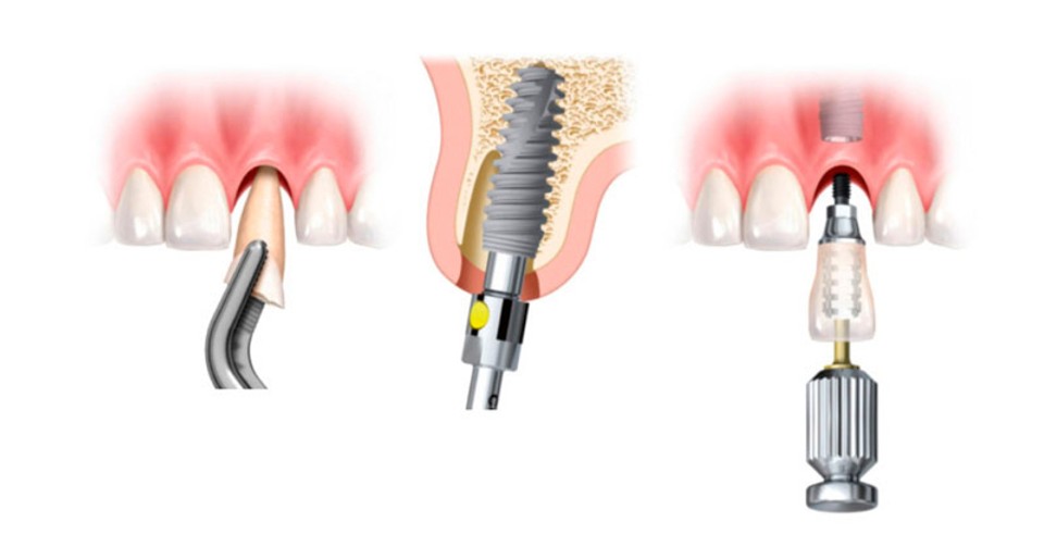 implantes dentales en un día es posible hacerlo