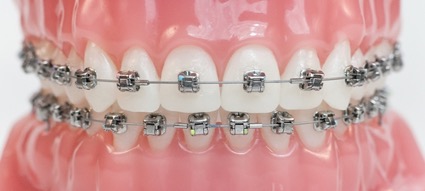 Cuidados en ortodoncia con brackets
