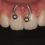 El uso de los piercings orales ¿qué riesgos puede tener en nuestra salud bucal?