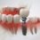 Implantes dentales en muelas ¿son necesarios?