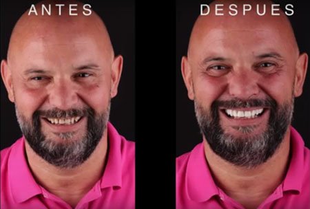 antes y despues tras DSD en clínica dental navarro Madrid