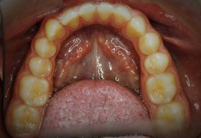 extracción de dientes caninos-2