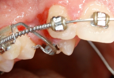 extracción de dientes caninos-3