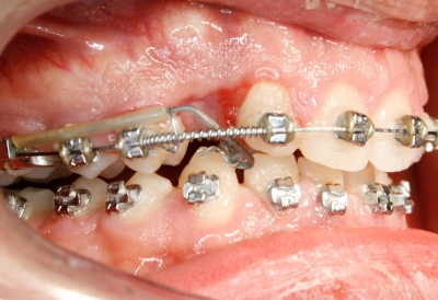 extracción de dientes caninos-7