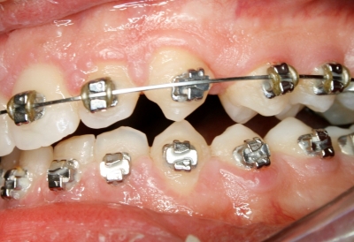 extracción de dientes caninos-8