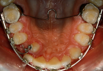 extracción de dientes caninos-9
