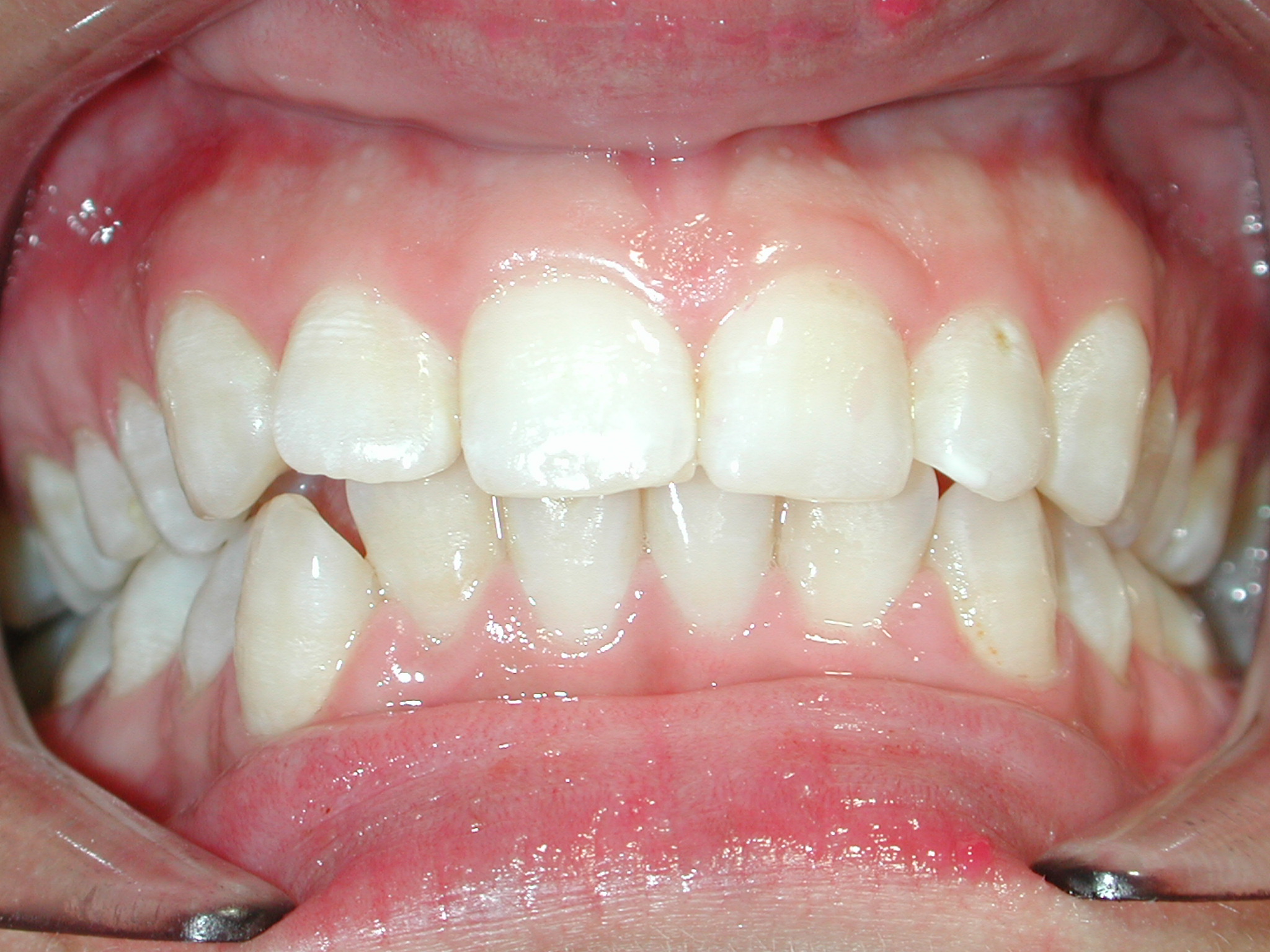 ortodoncia-antes-4