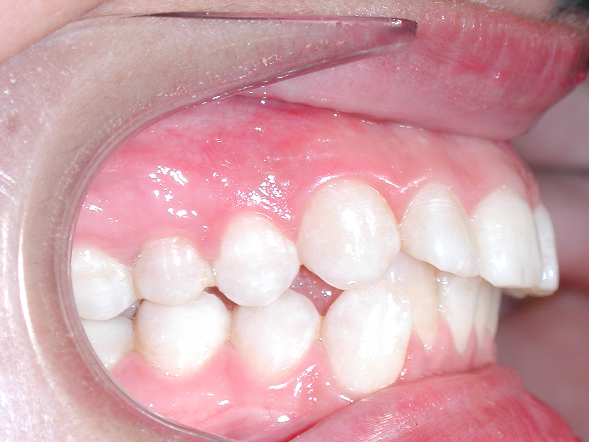 ortodoncia-antes-5