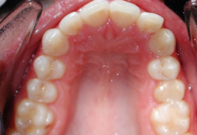 ortodoncia-antes-7