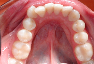 ortodoncia-antes-8
