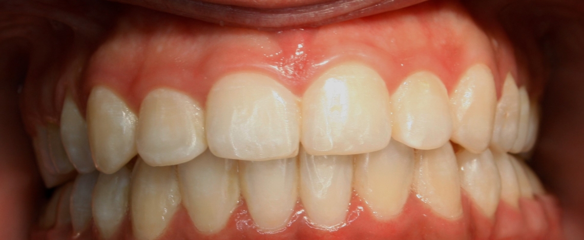 ortodoncia-después-4