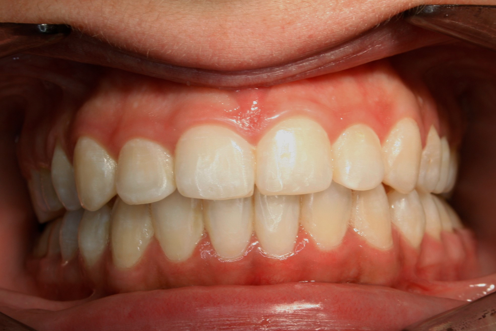 ortodoncia-después-4