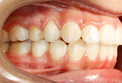 ortodoncia-después-5