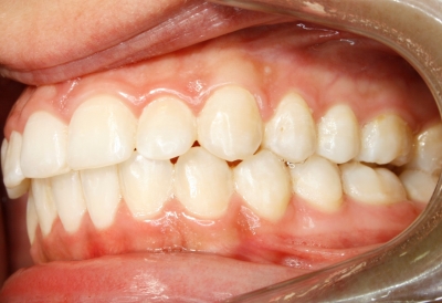 ortodoncia-después-6