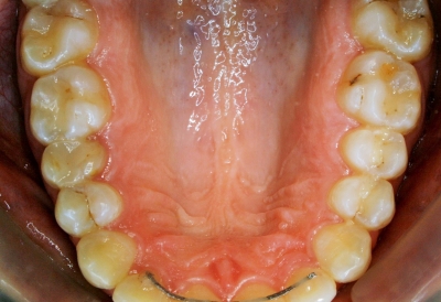 ortodoncia-después-7