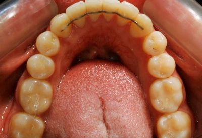 ortodoncia-después-8