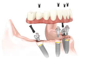 implantes dentales all on four