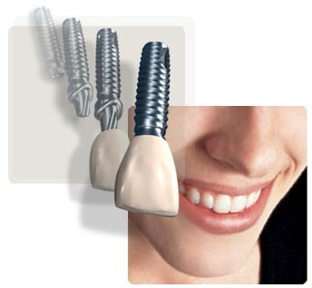 implantes dentales laminados