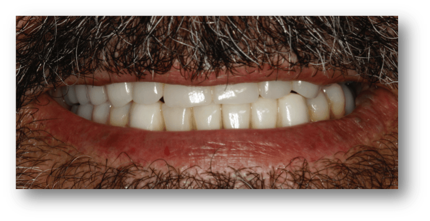 caso jose implantes dentales despues