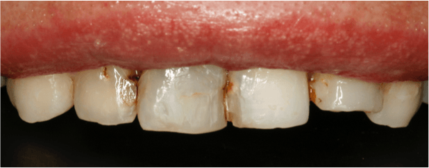 reconstruccion y rehabilitacion dental madrid1